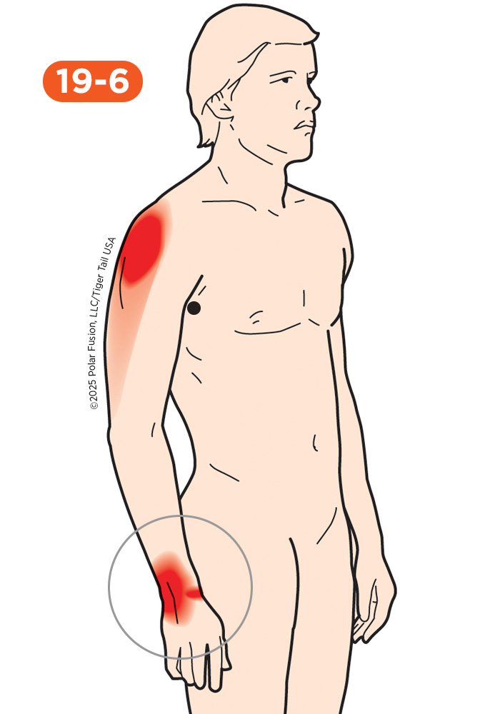 Wrist Pain 19-6 Subscapularis