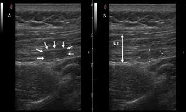 Grayscale ultrasound images from the patient participant. Area of myofascial trigger point was calculated. UT: upper trapezius. Photo by Azadeh Shadmehr
